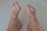 Dealing With High Arches in the Feet